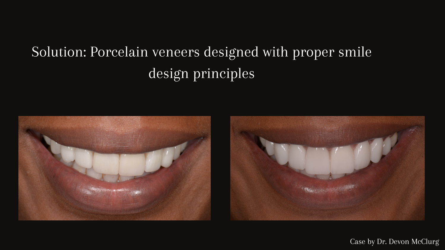 Problem_ Stained bonding and uneven smile 21.png