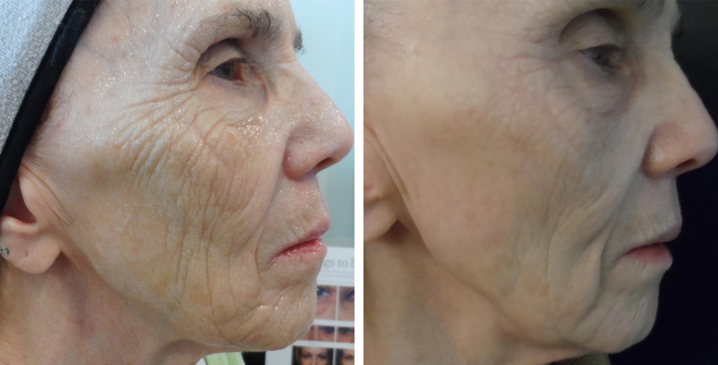 74 year-0ld woman before and after 4 micro-needling treatments