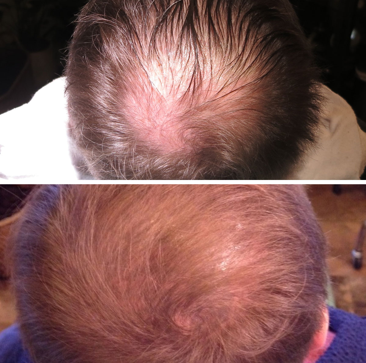 Healed after 30 days prior to follow up