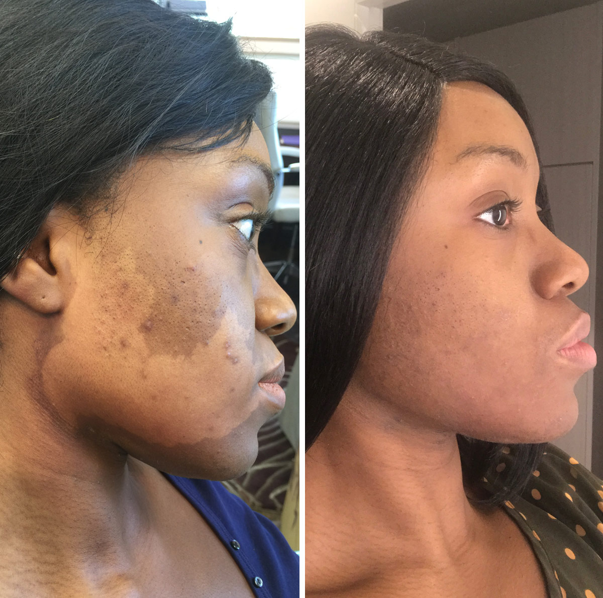 Seattle-Vitiligo1.jpg
