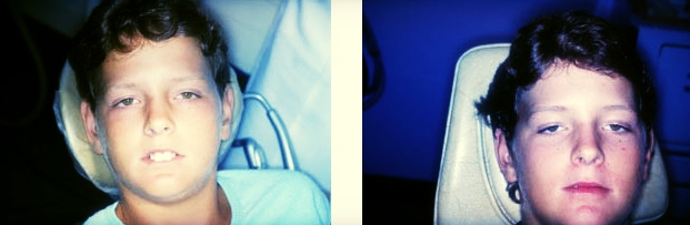 A patient of Dr Bourke - before and after Myo Munchee