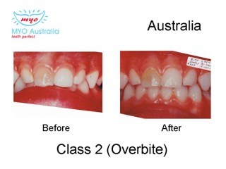 155-Overbite-myomunchee.jpeg