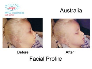 220-Facial-Profile-myomunchee.jpeg
