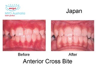 160-Anterior-cross-Bite-Jp-myomunchee.jpeg