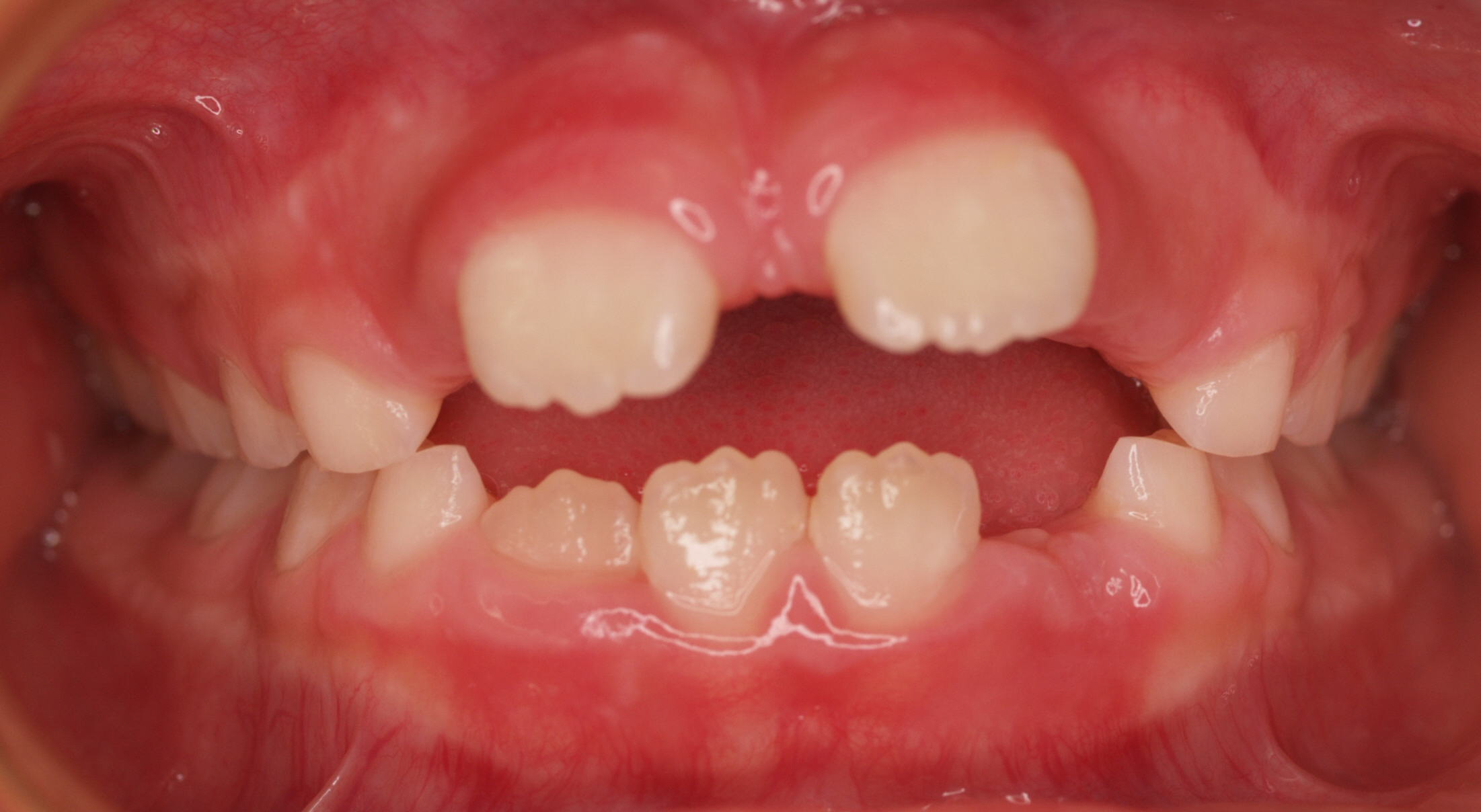 A typical anterior open bite