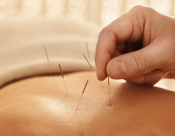Acupuncture and Adrenal Fatigue.jpg