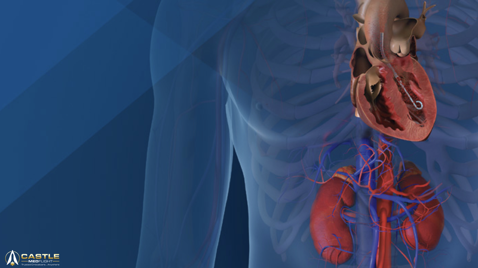An Impella device implanted in the left ventricle. 