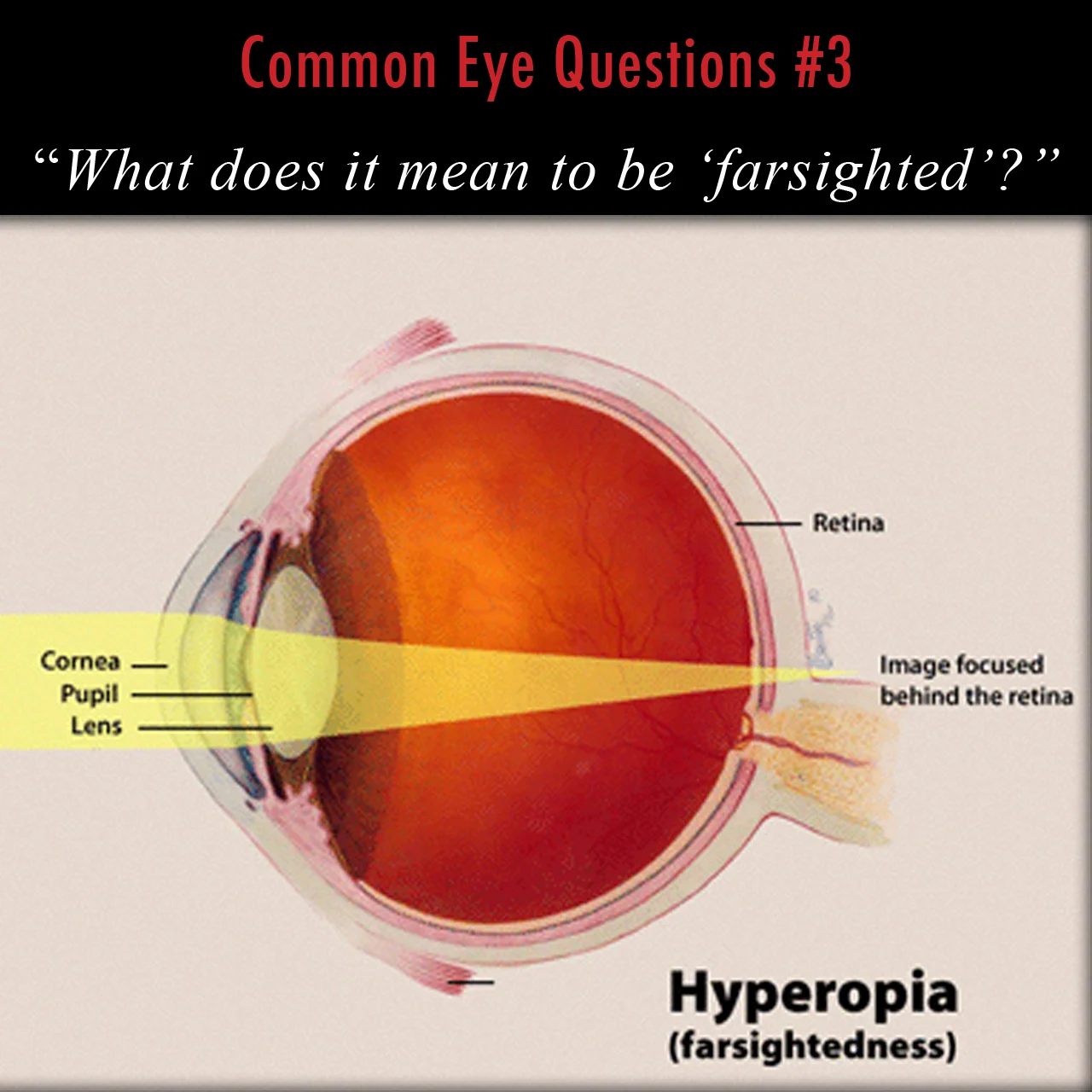 The anatomy of hyperopia, or farsightedness