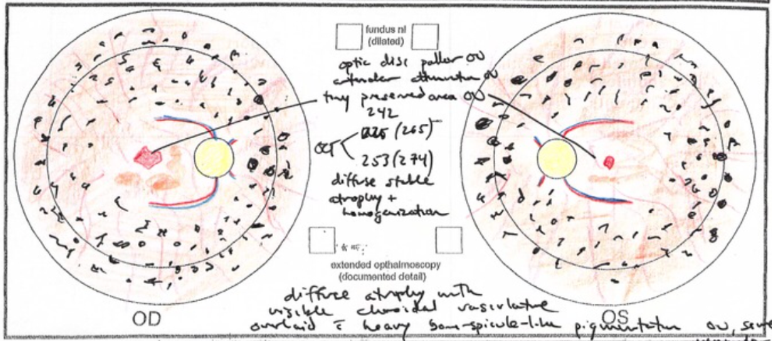 Autosomal recessive retinitis pigmentosa