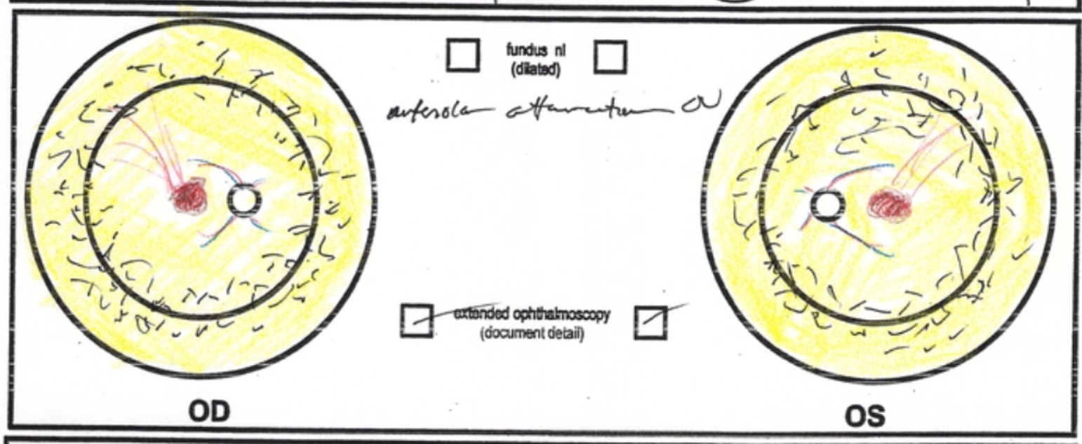 Autosomal dominant retinitis pigmentosa