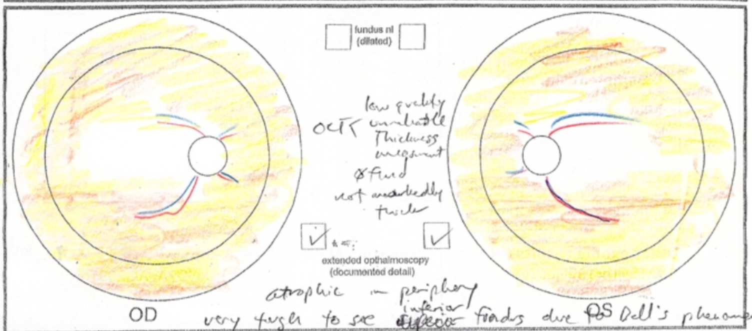Leber congenital amaurosis (LCA), not yet molecularly confirmed
