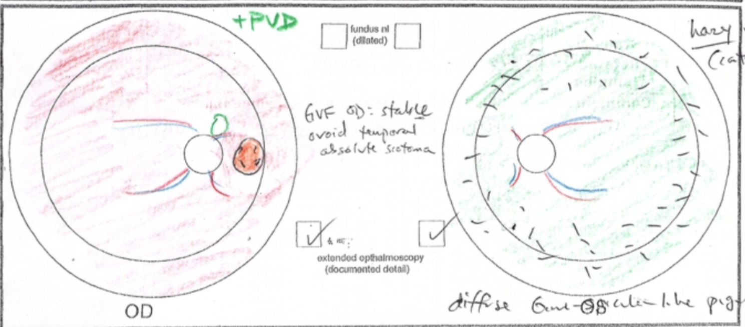Manifesting carrier of RP2-associated X-linked retinitis pigmentosa