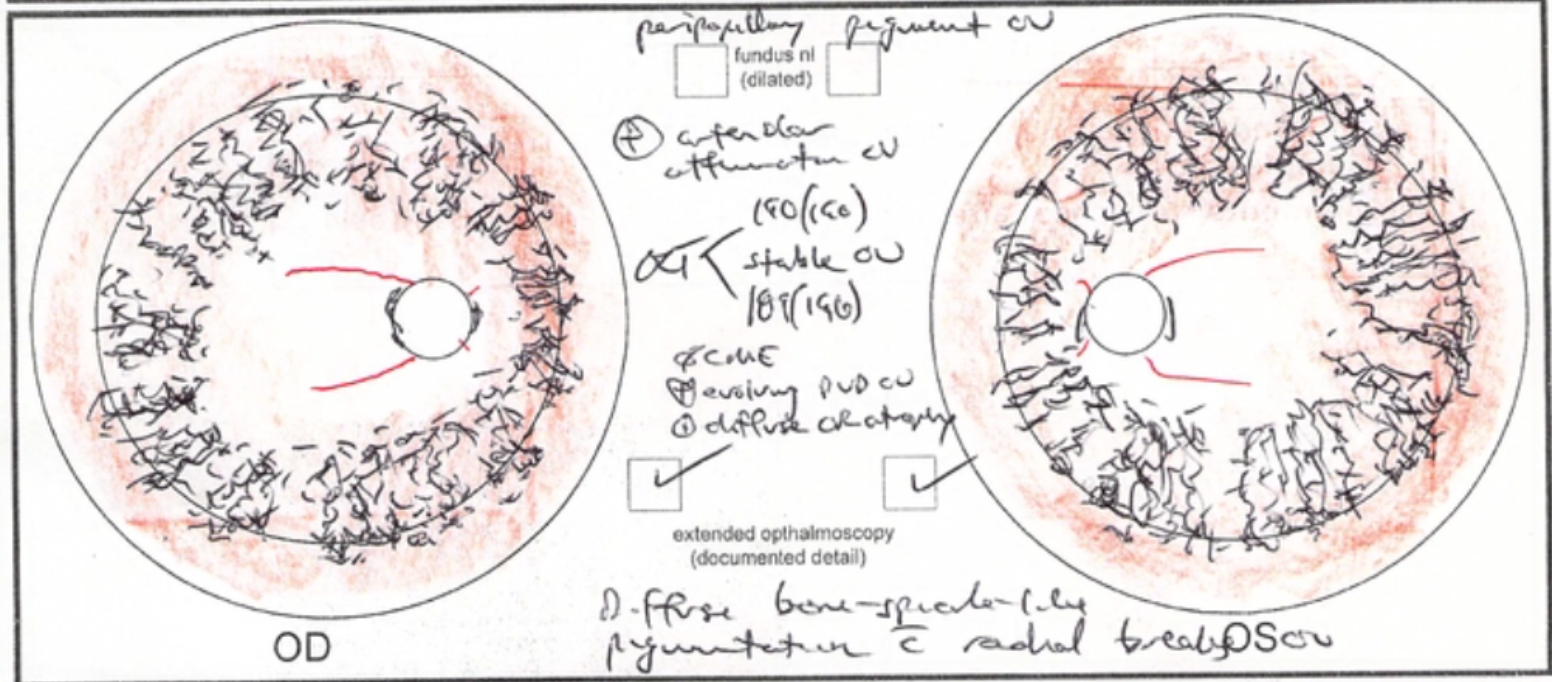 FLVCR-1 associated retinitis pigmentosa