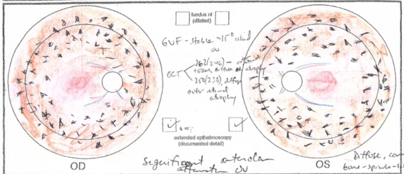 Autosomal recessive retinitis pigmentosa