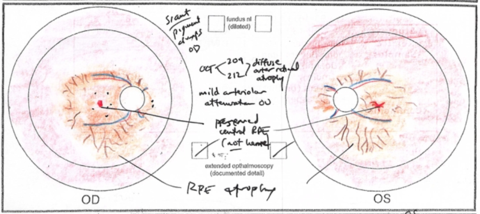 RPGR-associated X-linked retinitis pigmentosa