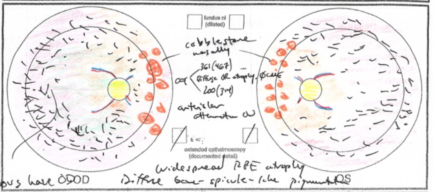 USH2a-associated type 2 Usher syndrome