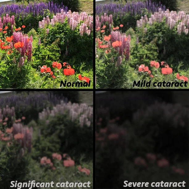 u cataract.jpg
