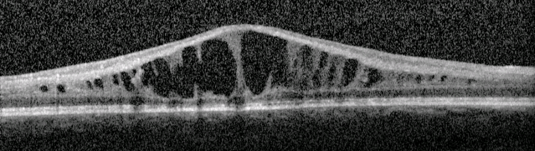 Here is an example of the retina in a patient with X-linked retinoschisis. Note the cystic spaces created by the defective retinoschisin protein.
