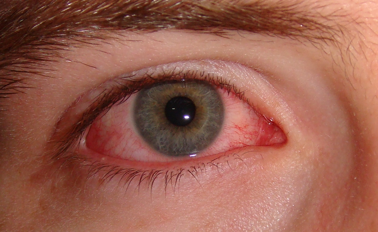 Wandering eye syndrome