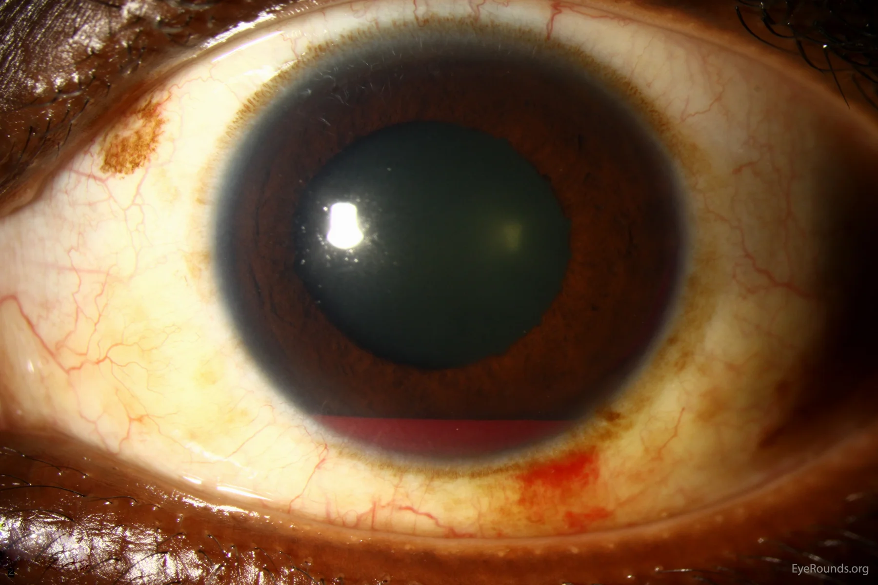 hyphema-1-LRG.jpg