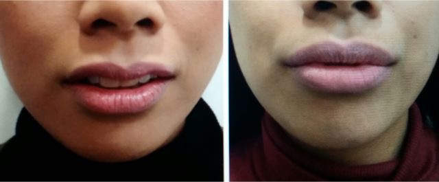 Lip enhancement with dermal filler
