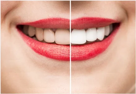 dentes.jpg
