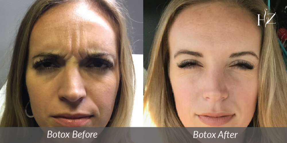 arcadia botox