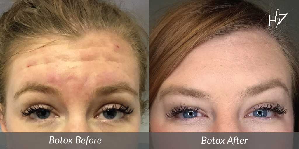 does botox hurt, botox injections, does work work