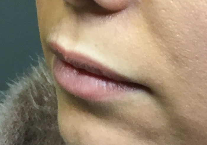 BEFORE (Juvederm Ultra)