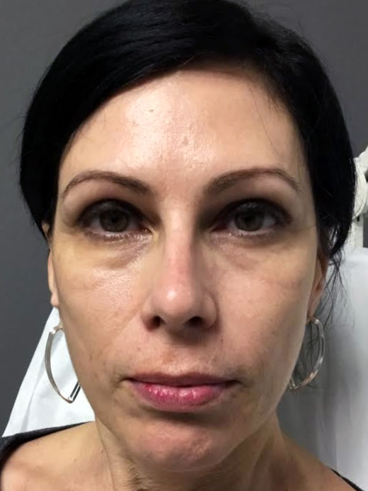 AFTER (Vollure, Voluma, &amp; Sculptra)