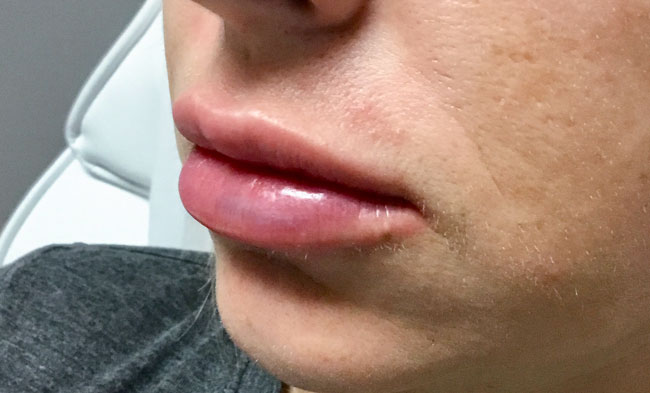 AFTER (Juvederm Ultra)