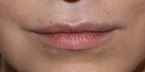 BEFORE (Juvederm Ultra)