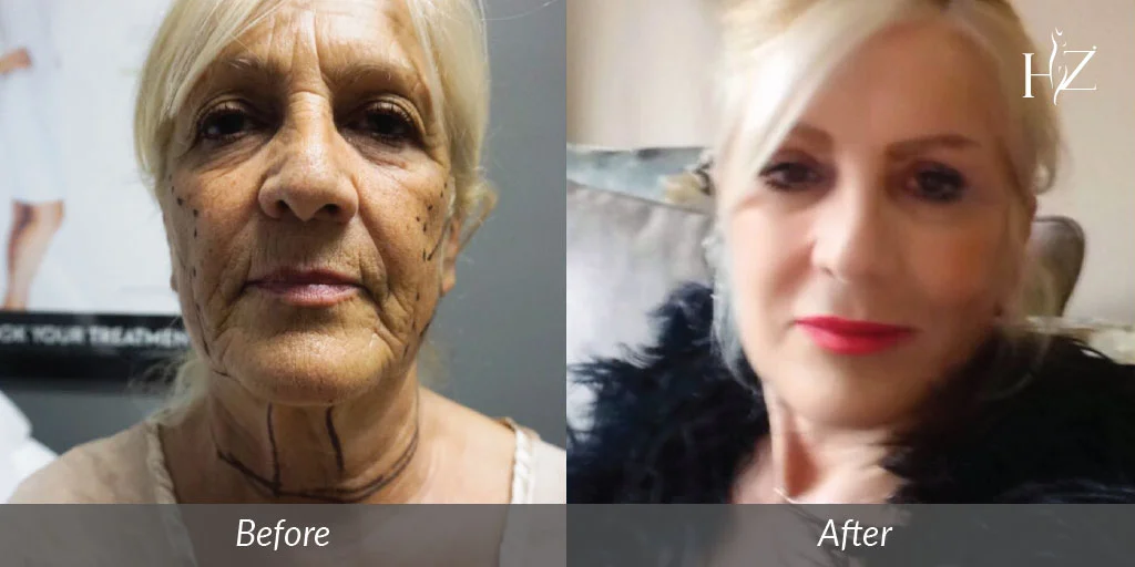 blepharoplasty+orlando,+blepharoplasty+before+after,+blepharoplasty+surgery.jpg