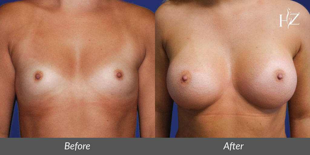 breast+augmentation+orlando,+breast+augmentation+before+and+after-2.jpg