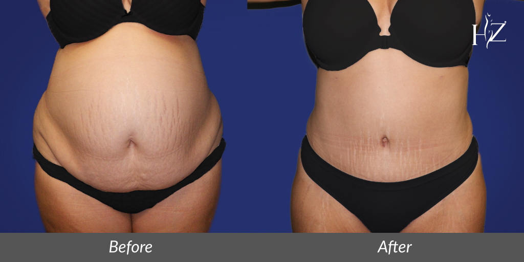 Are You a Candidate for Tummy Tuck? - Salas Plastic Surgery