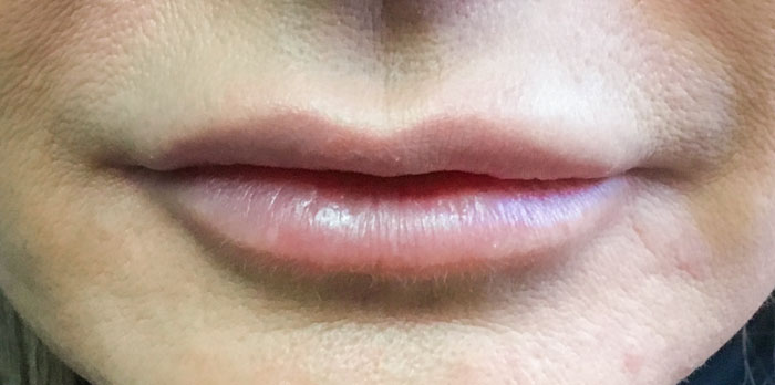 AFTER (Juvederm Ultra)