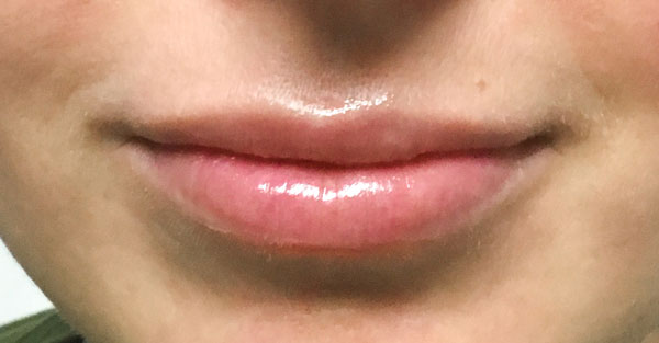 AFTER (Juvederm Ultra)