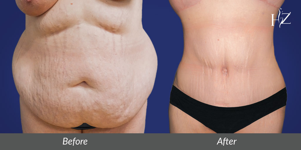 Tummy Tuck Price Austin