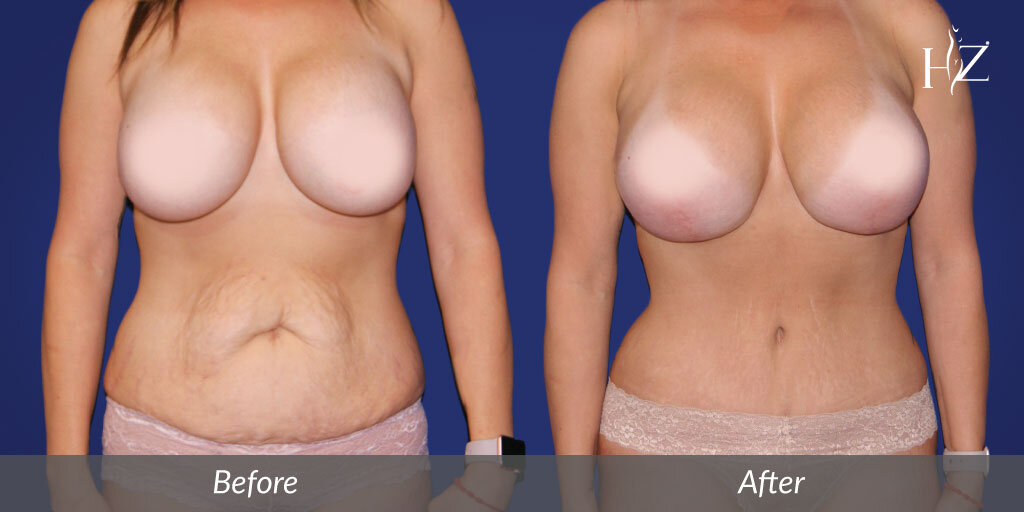 tummy+tuck+before+and+after,+tummy+tuck+orlando,+hz+plastic+surgery.jpg