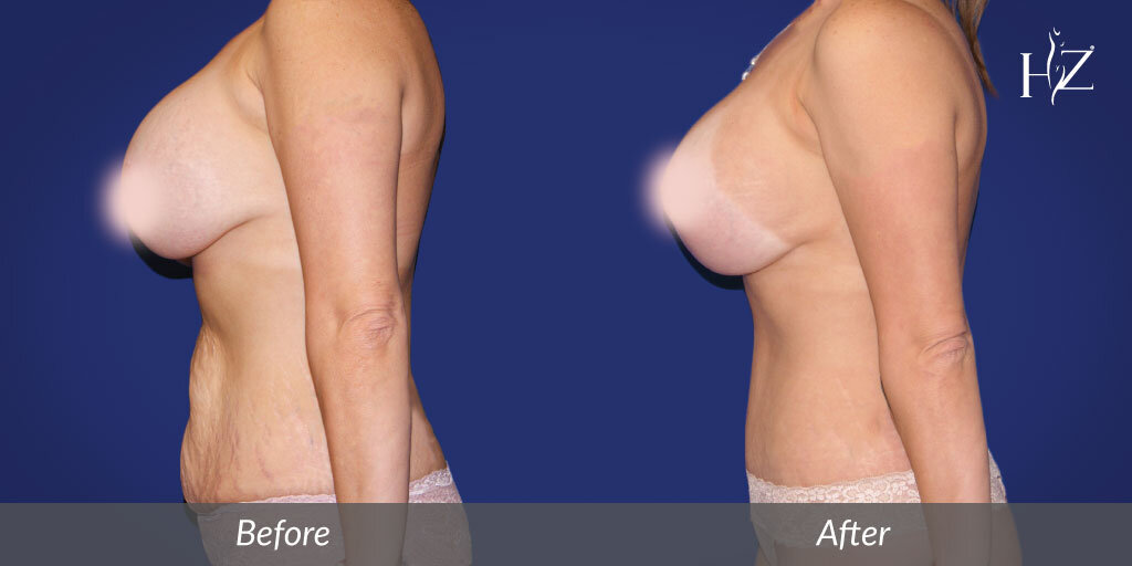 tummy+tuck+before+and+after,+tummy+tuck+orlando,+hz+plastic+surgery-1.jpg