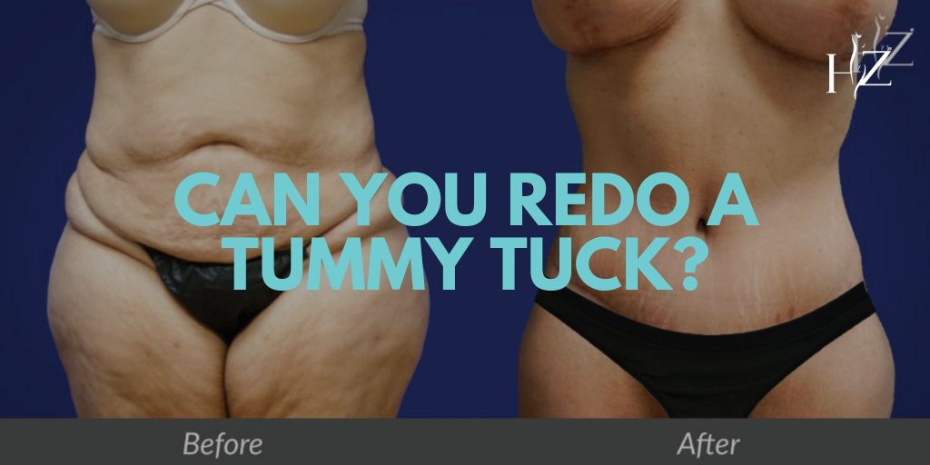 Can You Redo A Tummy Tuck? — HZ Plastic Surgery