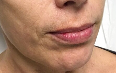 AFTER (Vollure, Voluma, &amp; Sculptra)