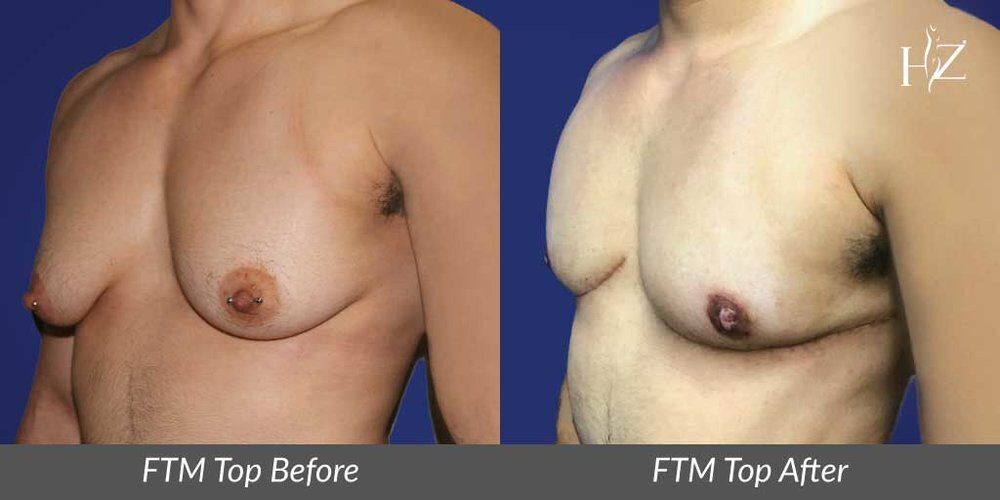 ftm+top+surgery+orlando,+female+to+male+top+surgery+orlando,+ftm+top+surgery+before+and+after (1).jpeg