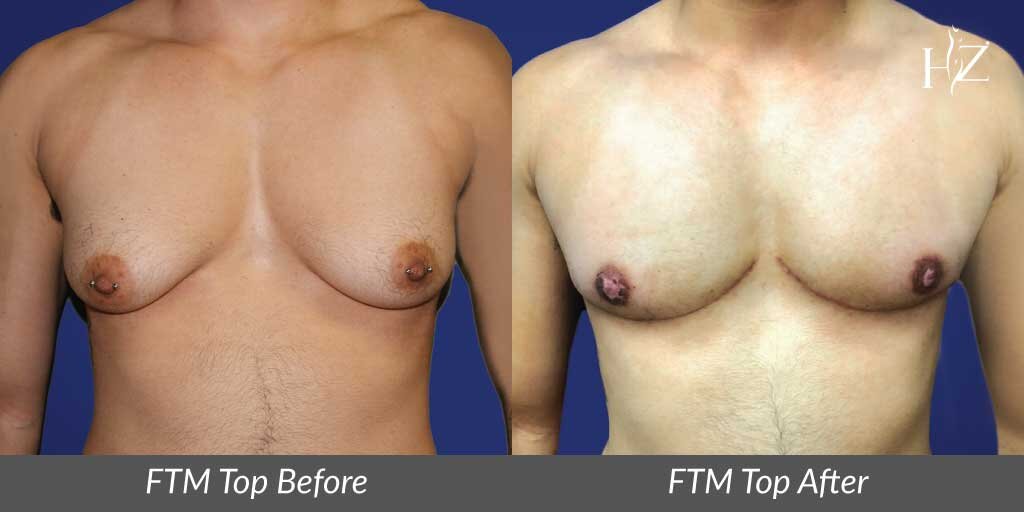 ftm+top+surgery+orlando,+female+to+male+top+surgery+orlando,+ftm+top+surgery+before+and+after.jpeg