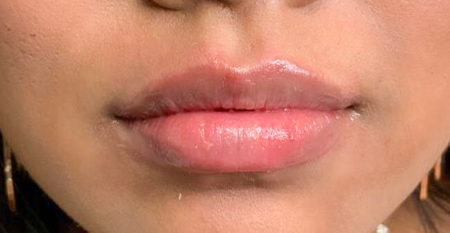 AFTER (Juvederm Ultra)