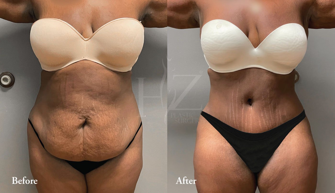 Tummy Tuck And Liposuction By Dr. Harun Zekirovski