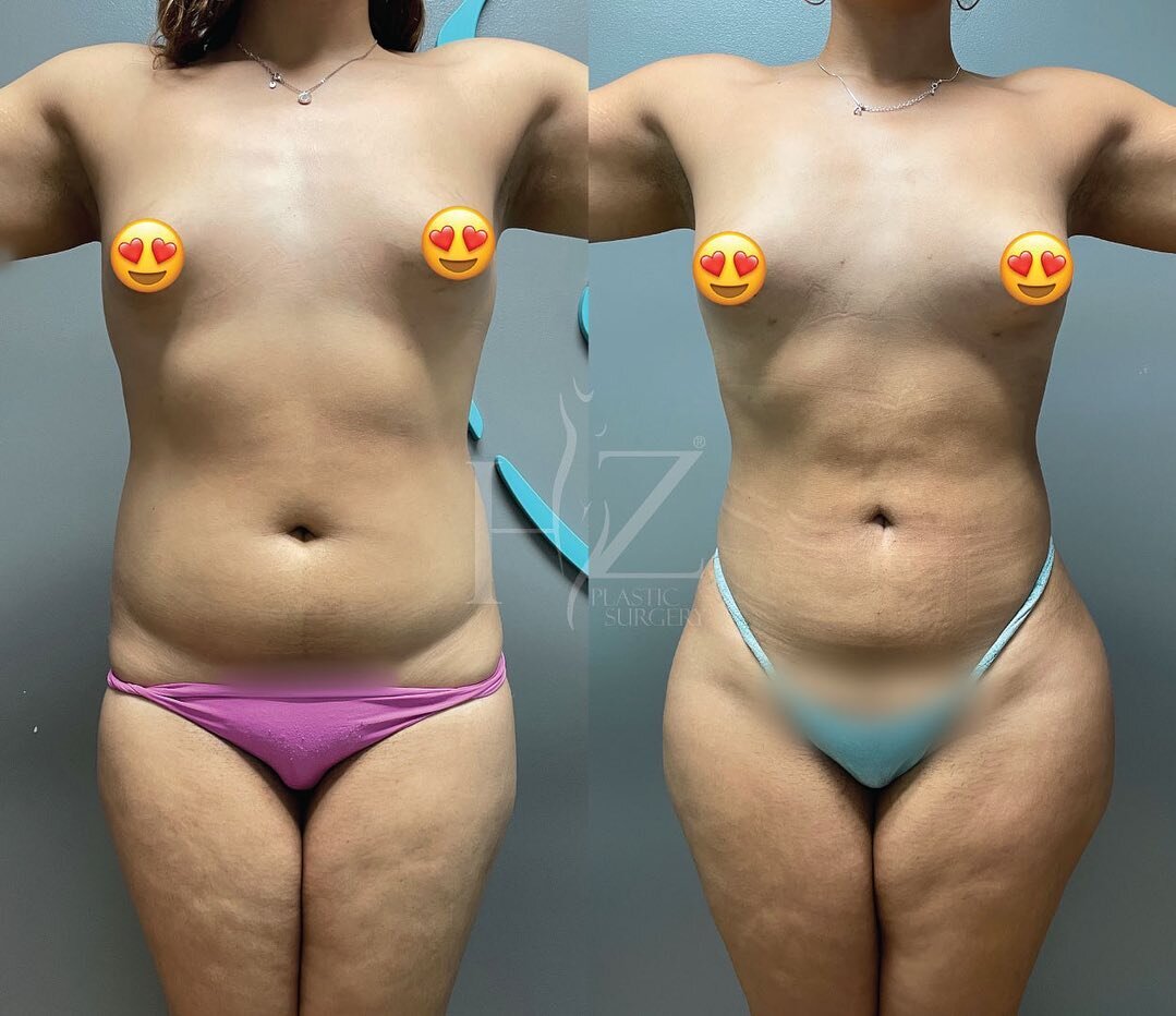 Liposuction of 2023 🔥 
Did you know there are over 20 areas of the body we can liposuction? Swipe to the end to see the different areas that can be addressed!

1: Liposuction on waist, back bra roll, upper abdomen, and lower abdomen PLUS fat graftin