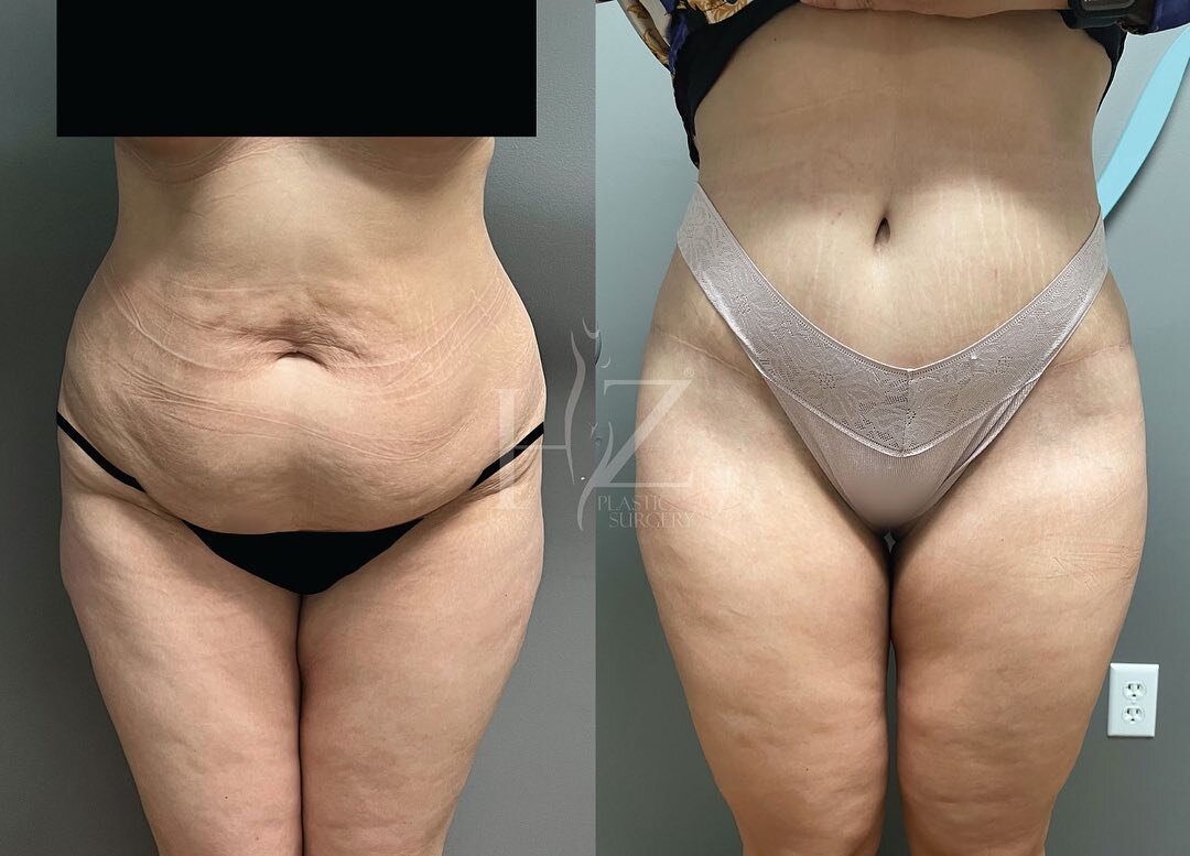 Tummy tucks of 2023 😍 
We&rsquo;re ending the first week of 2023 with a spotlight on one of our most popular procedures! Swipe through to see some of our gorgeous patient transformations from last year. Visit our website for our full gallery! 

1: B