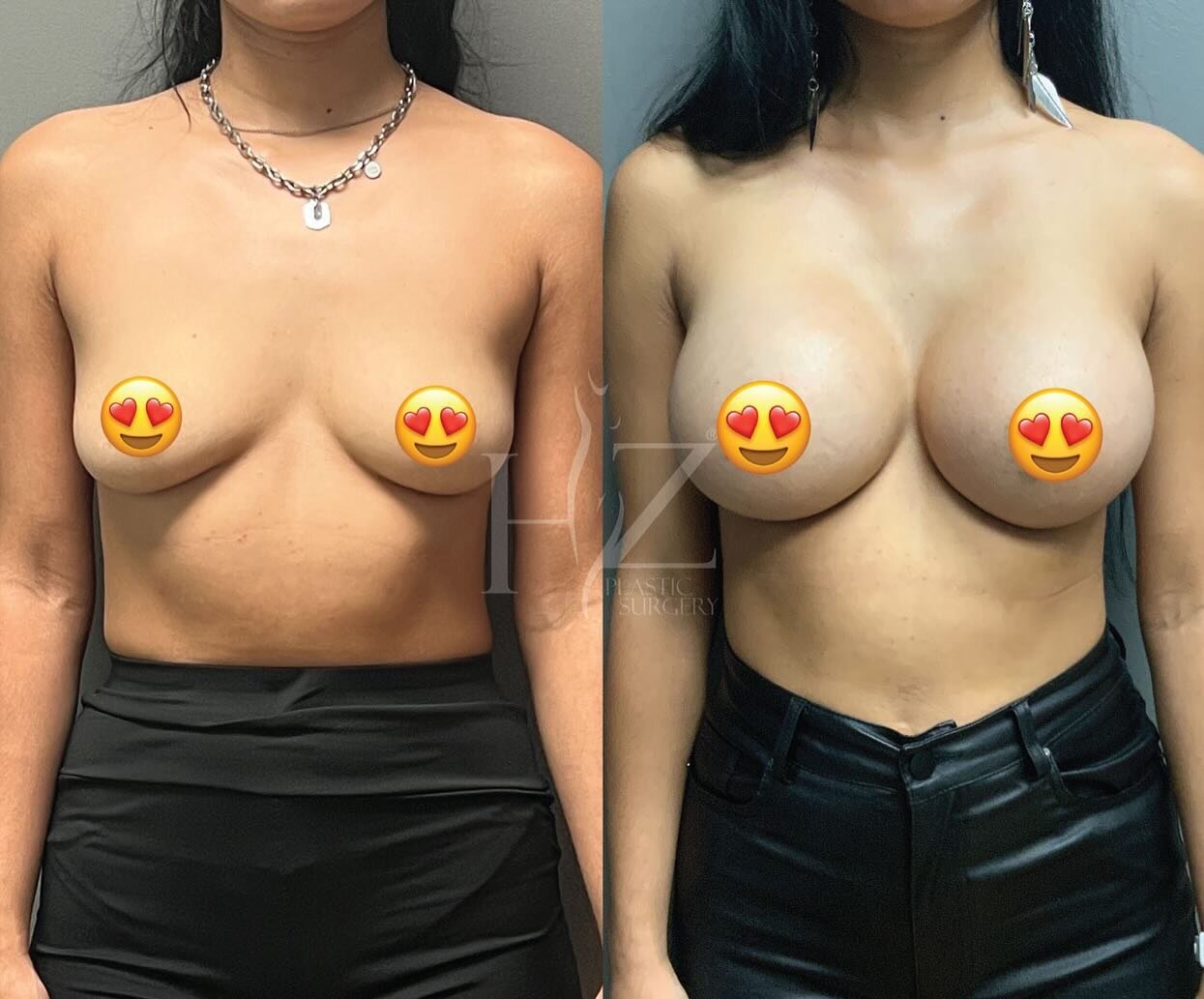 Recent breast augmentations 🔥 
Patients who have surgery within two months can access unprecedented discounts between 10-23% off their highest surgical fee through our Swift Savings Program! We have limited spots available on a first-come, first-ser