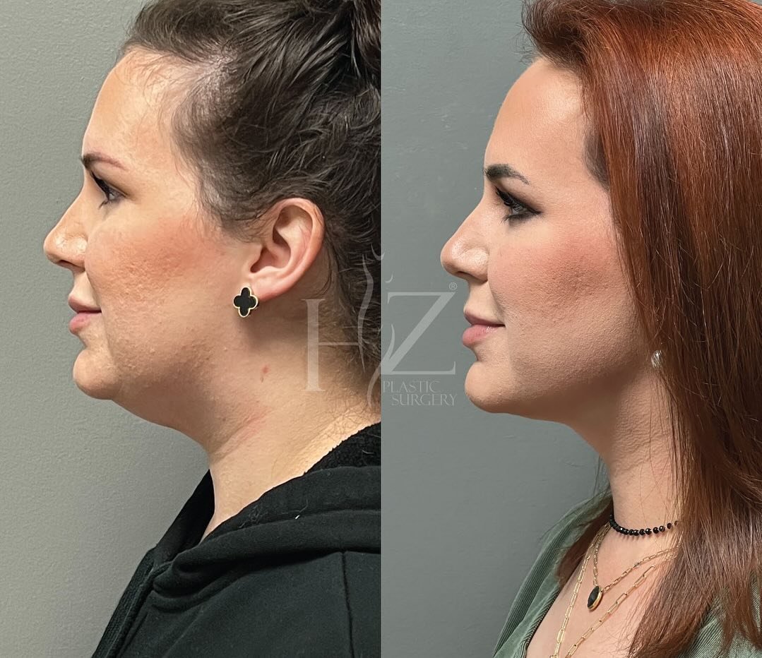 A little lipo can go a loooong way 👏 
Swipe through our chin liposuction gallery to see the impact of one of our increasingly popular procedures.

Consults available as soon as NEXT week! 🗓️ 

1: By @drlylyhzps at 6 weeks post-op
2: By @drlylyhzps 